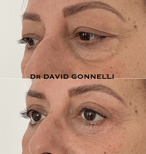 blepharoplastie marseille