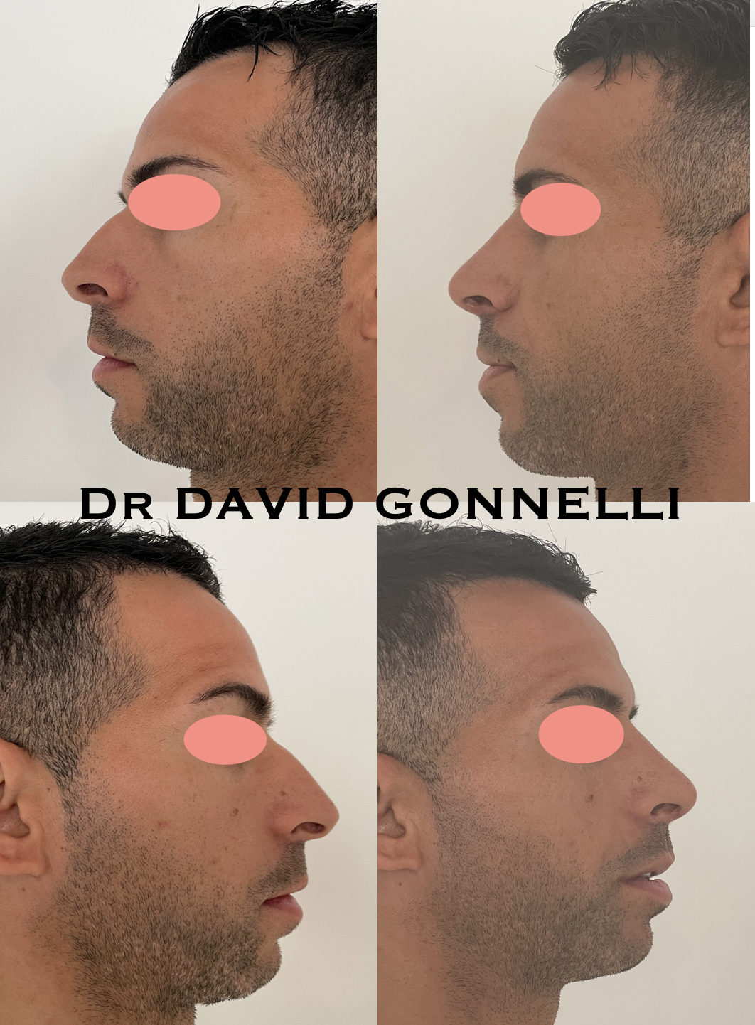 rhinoplastie marseille