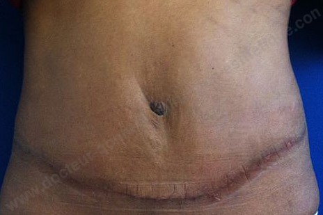 abdominoplastie marseille