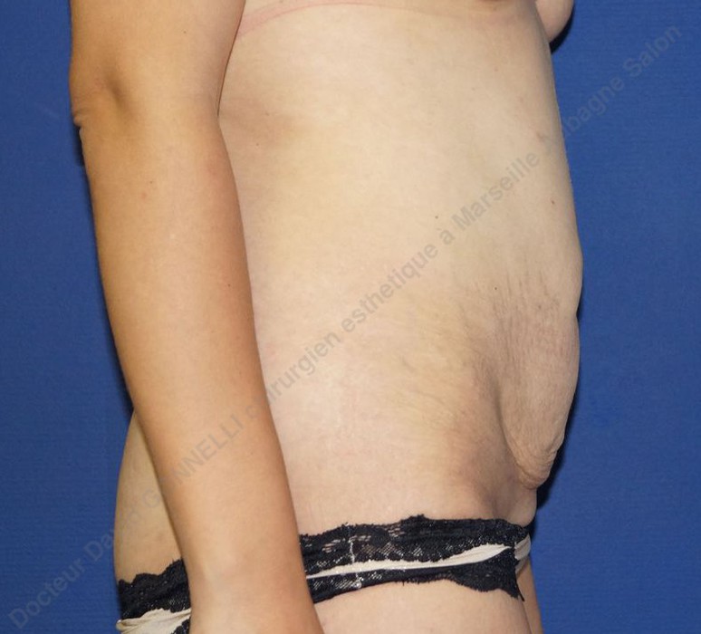 abdominoplastie tarif