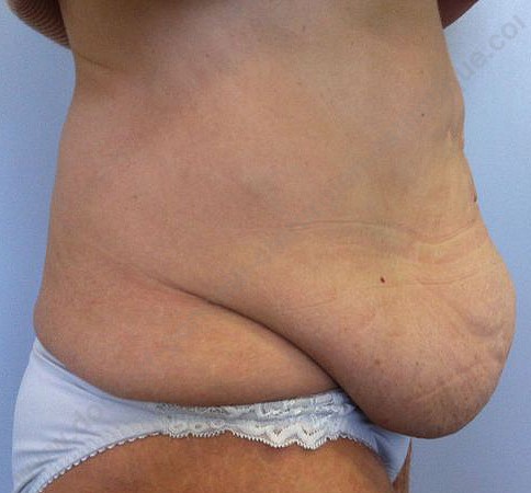 chirurgie abdominale prix