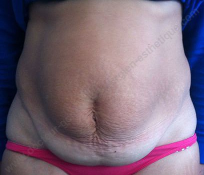 chirurgie reparatrice apres grossesse