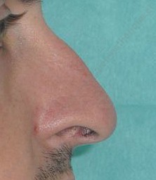 chirurgie esthtique nez