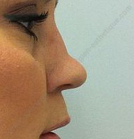 rhinoplastie marseille