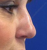 rhinoplastie prix