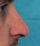 rhinoplastie