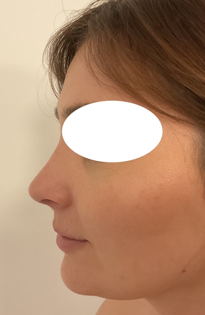 rhinoplastie à marseille