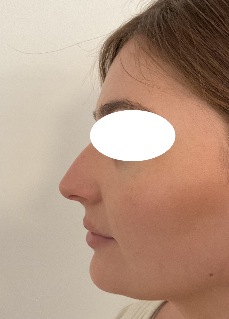 rhinoplastie à marseille