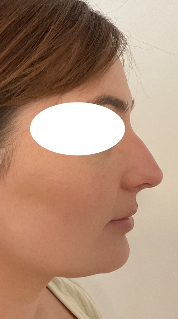 rhinoplastie à marseille