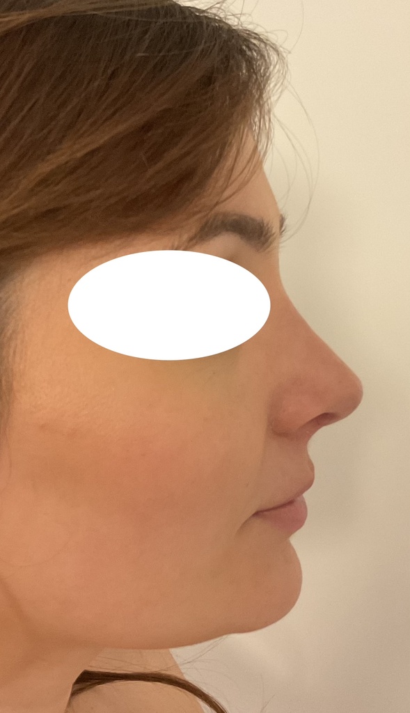 rhinoplastie à marseille