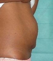 Abdominoplastie Marseille