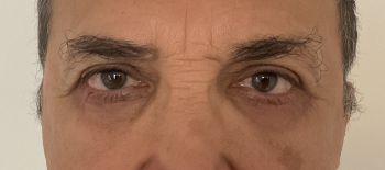 BLEPHAROPLASTIE SUPERIEURE ET INFERIEURE