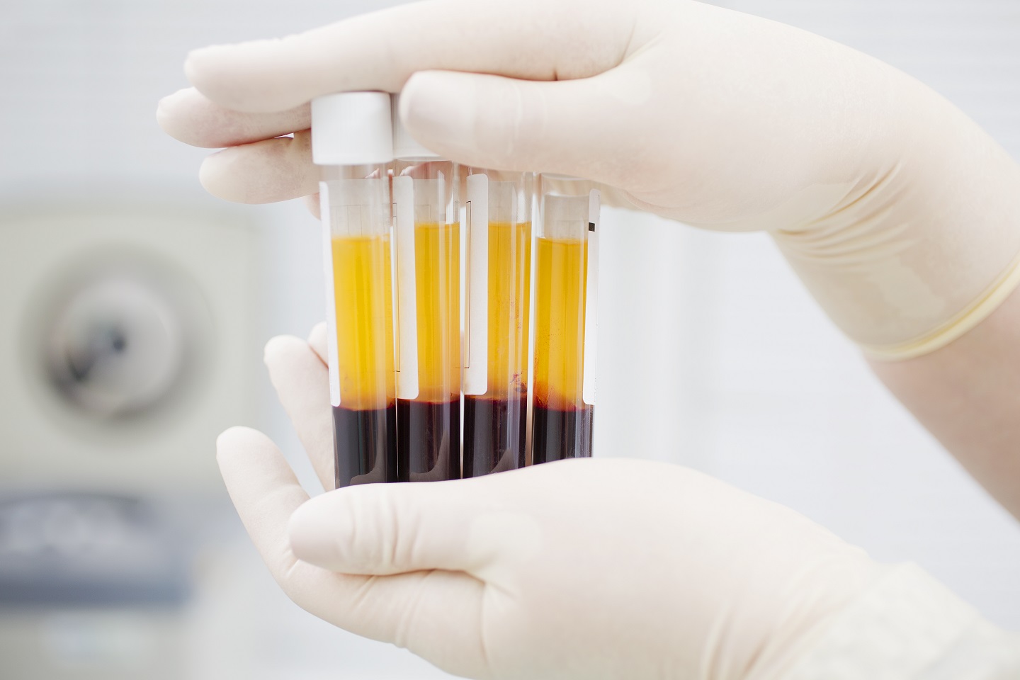 injection plasma plaquette