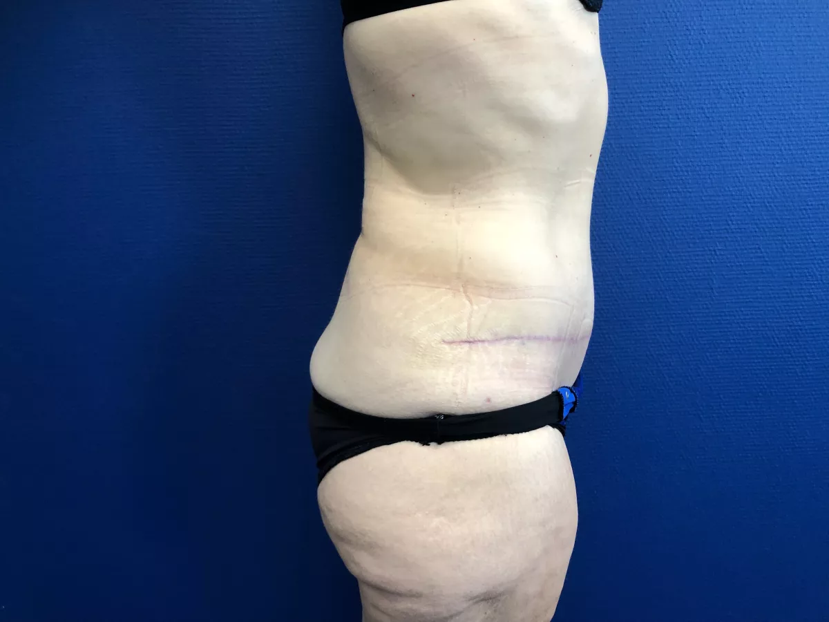 abdominoplastie