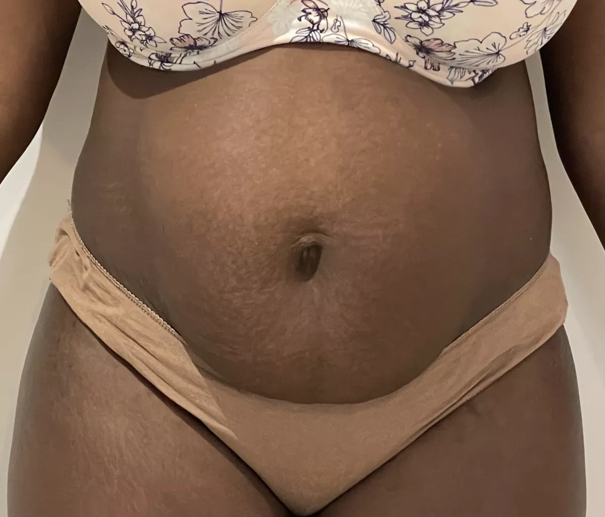 Abdominoplastie et diastasis musculaire à Marseille