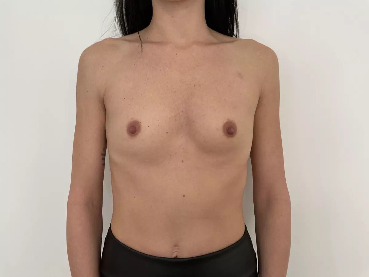 Augmentation mammaire par prothèses rondes ergonomiques