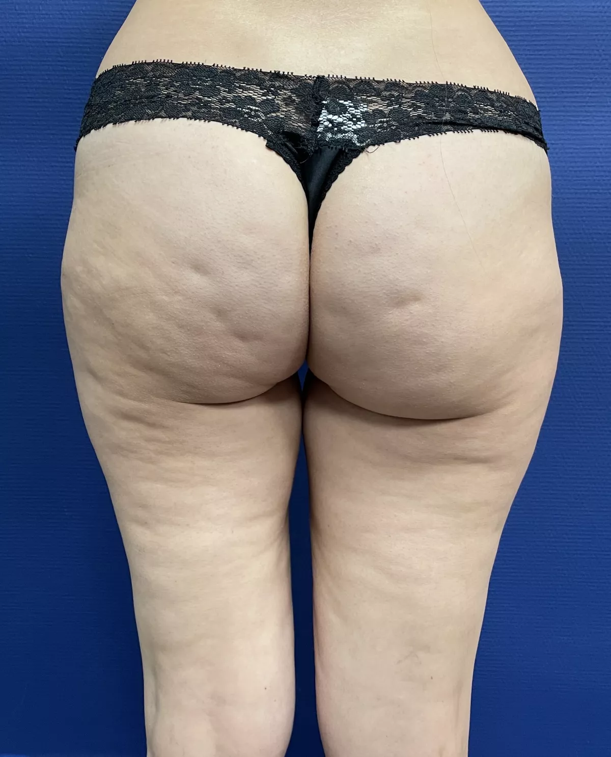 Liposculpture des fesses