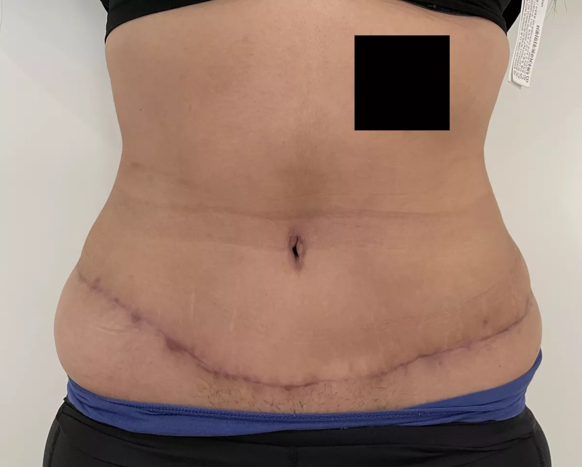 abdominoplastie marseille