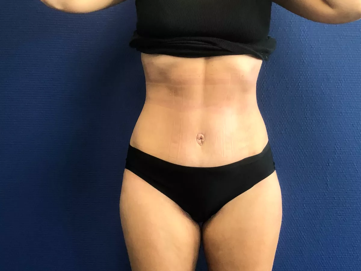 abdominoplastie marseille