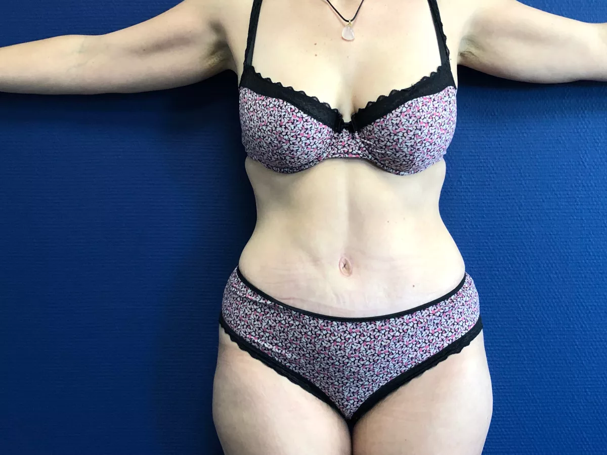 Abdominoplastie post grossesse