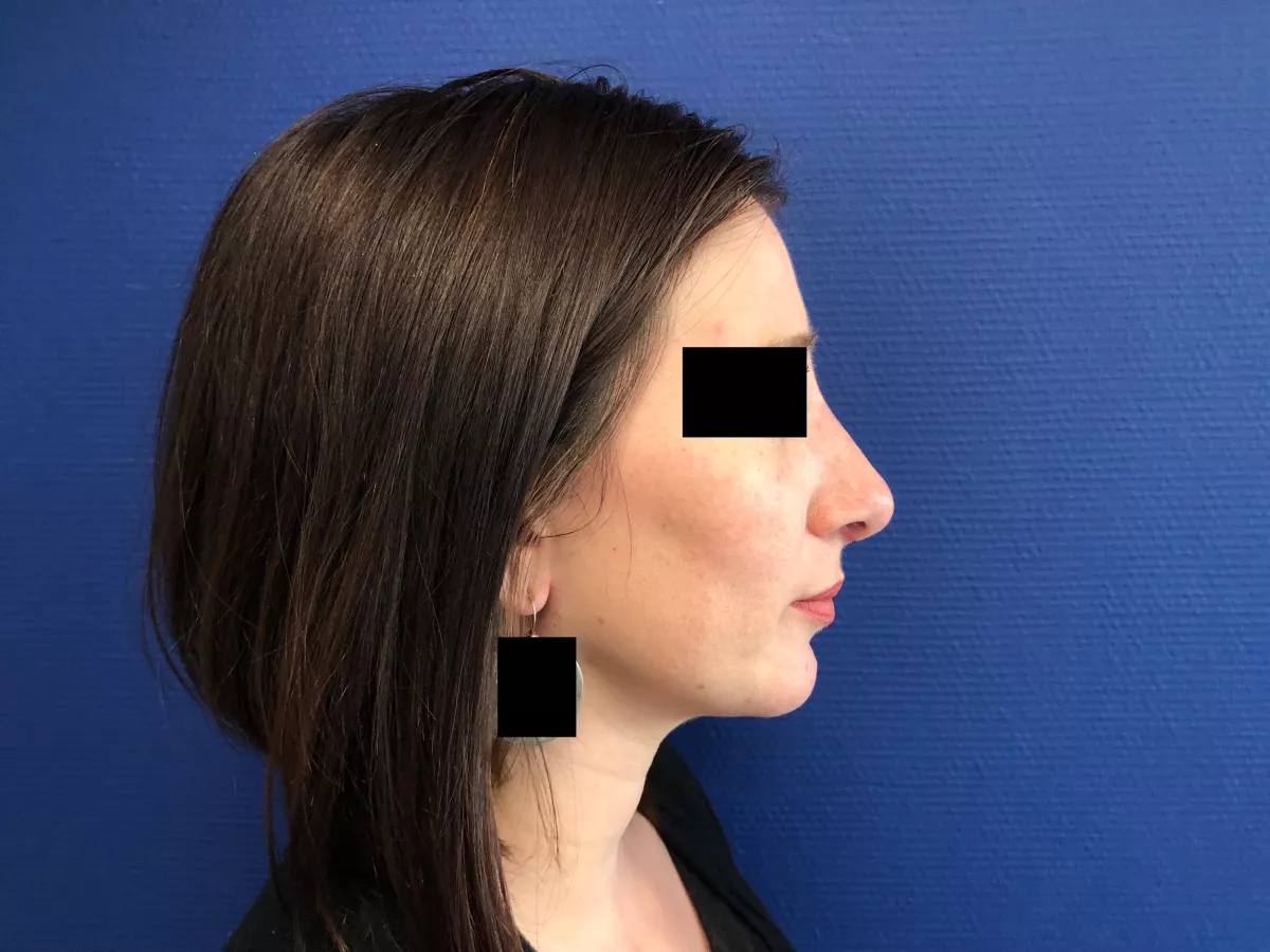 rhinoplastie aubagne