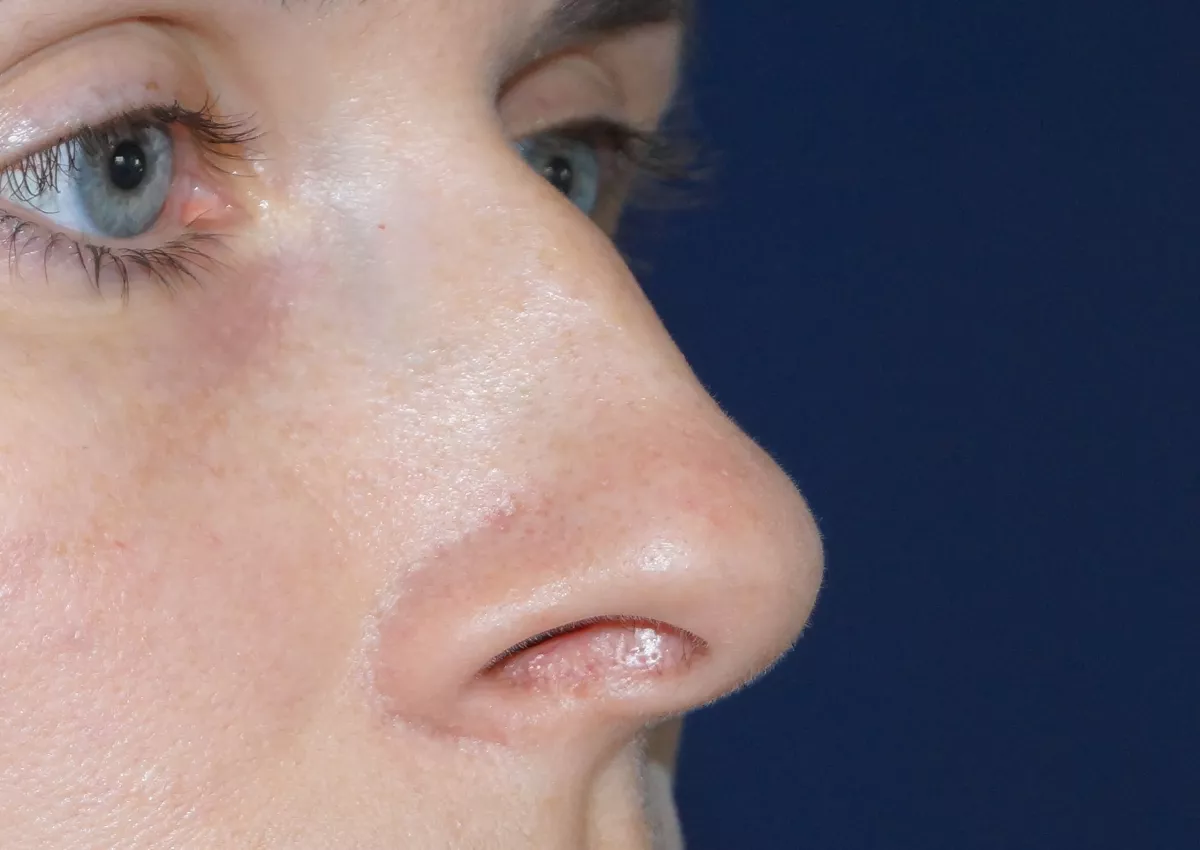 chirurgie du nez marseille