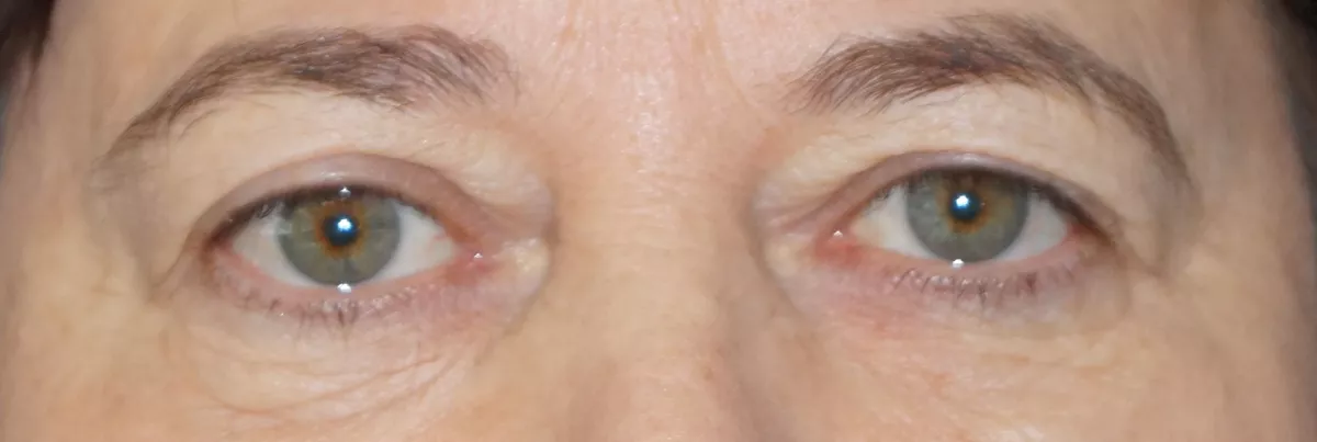 blepharoplastie marseille