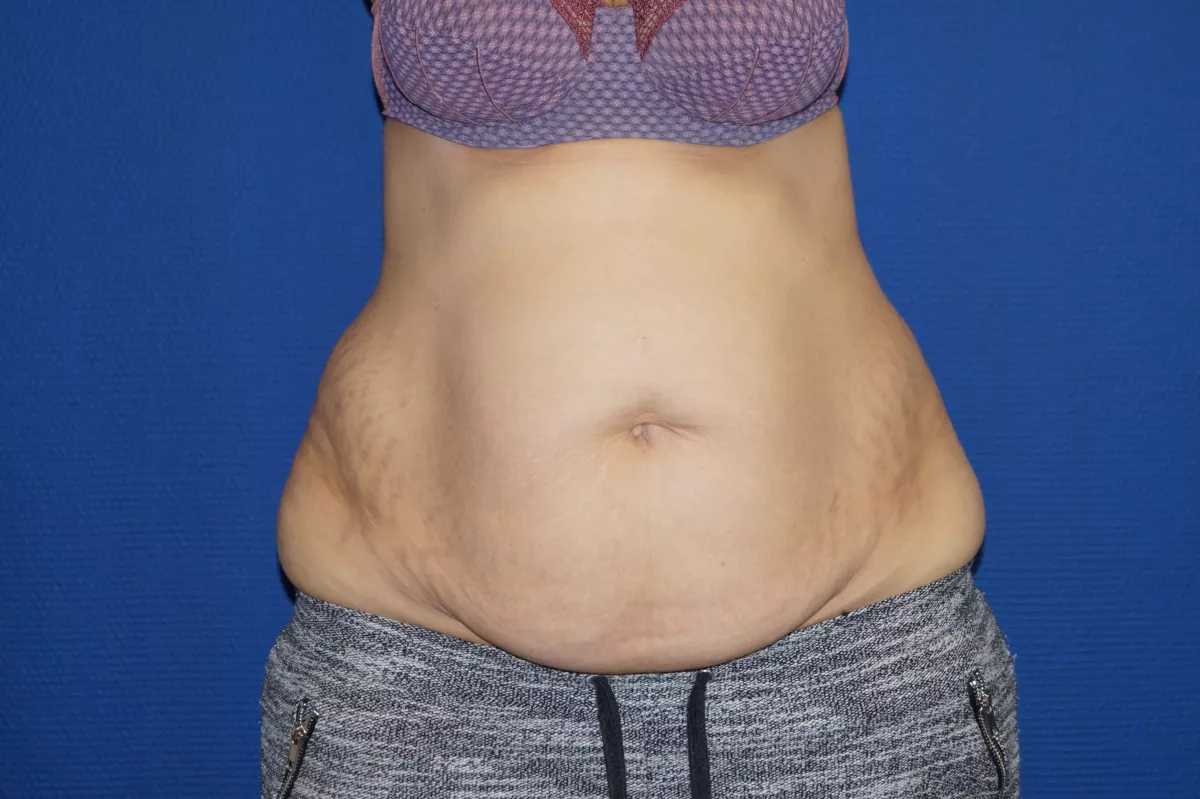 abdominoplastie marseille