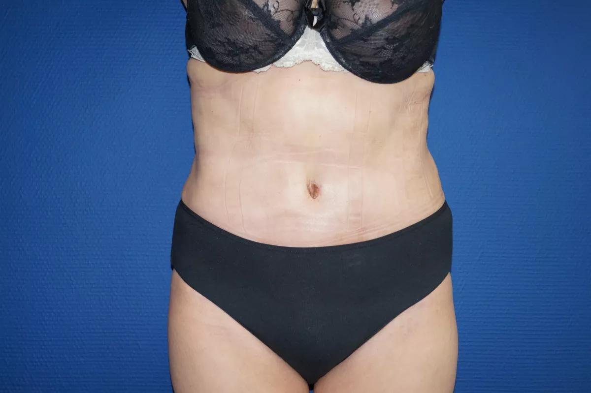 abdominoplastie marseille