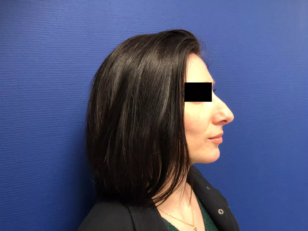 rhinoplastie marseille