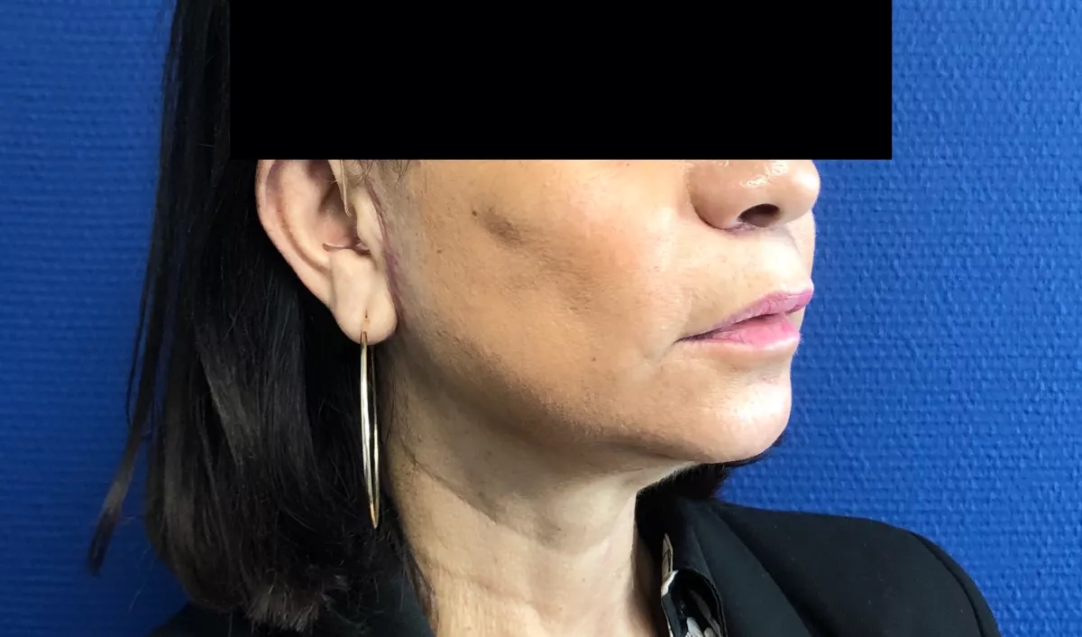 lifting cervico facial