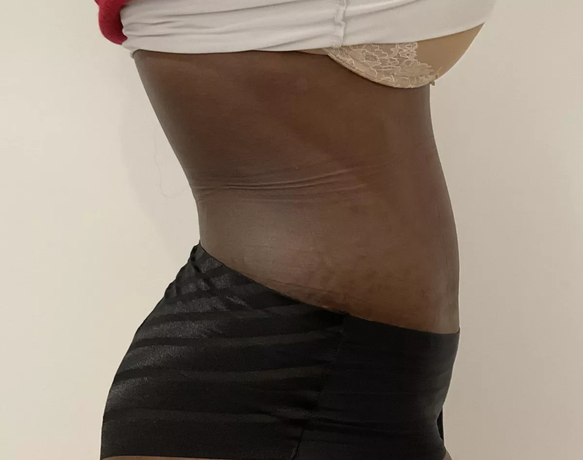 Abdominoplastie et diastasis musculaire à Marseille