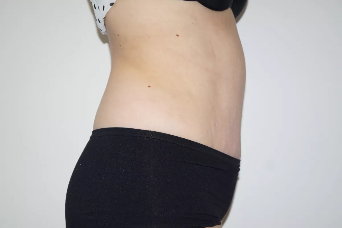 abdominoplastie marseille