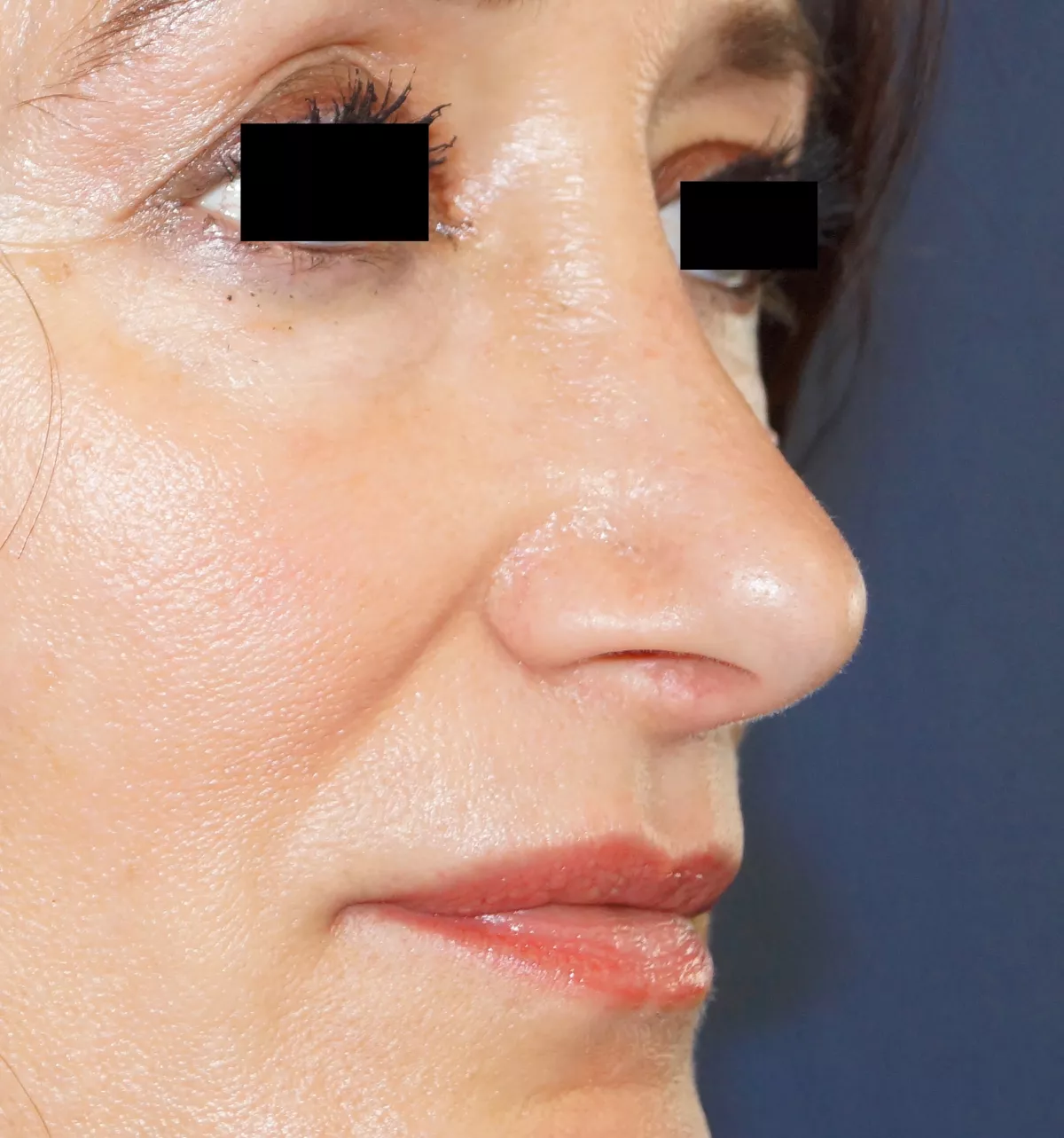 rhinoplastie voie externe