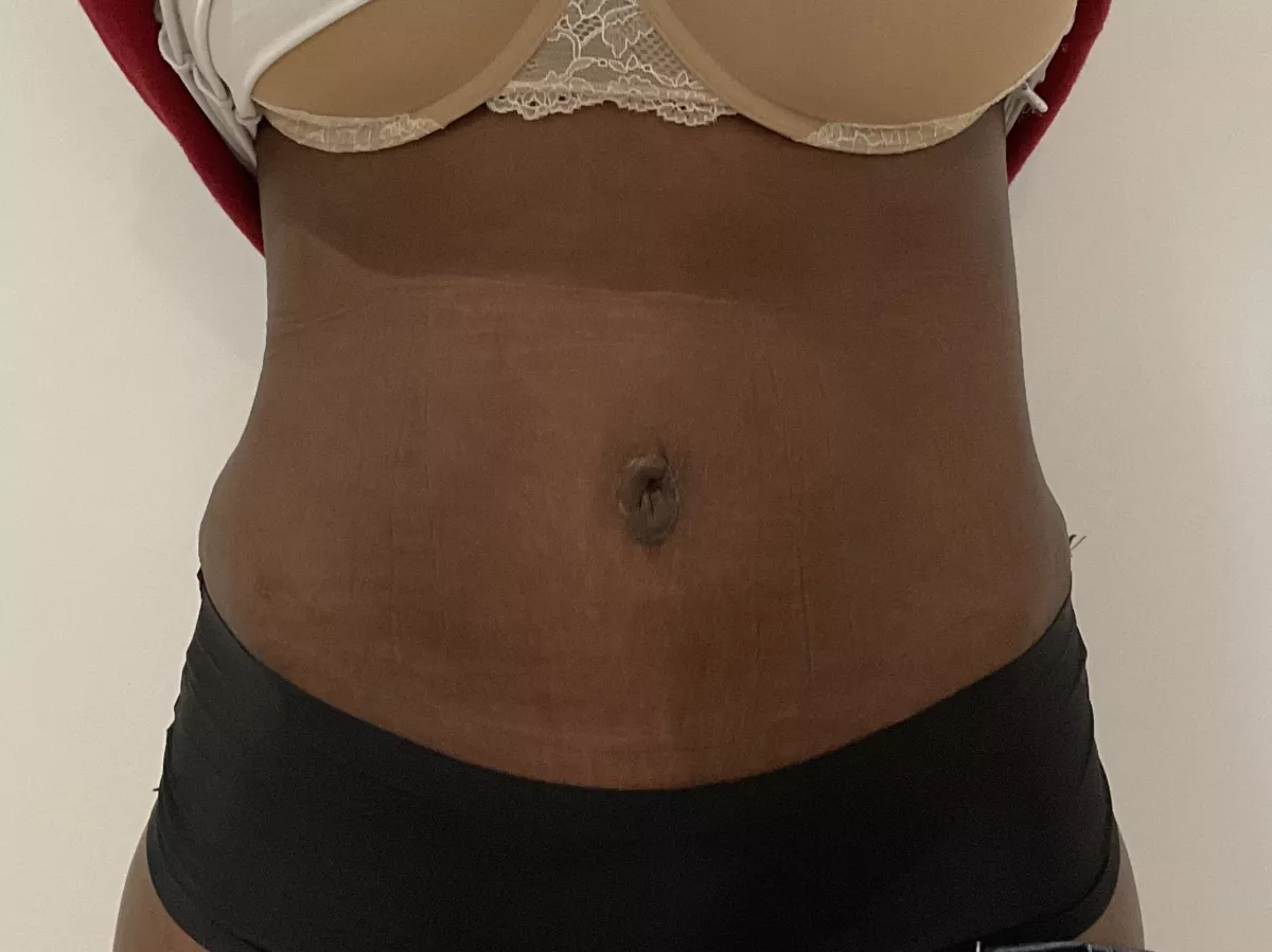 Abdominoplastie et diastasis musculaire à Marseille