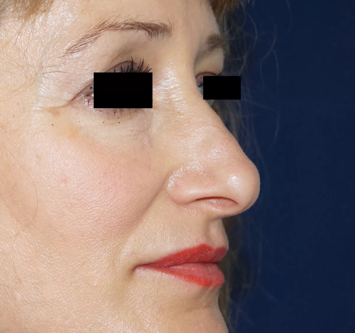 rhinoplastie marseille