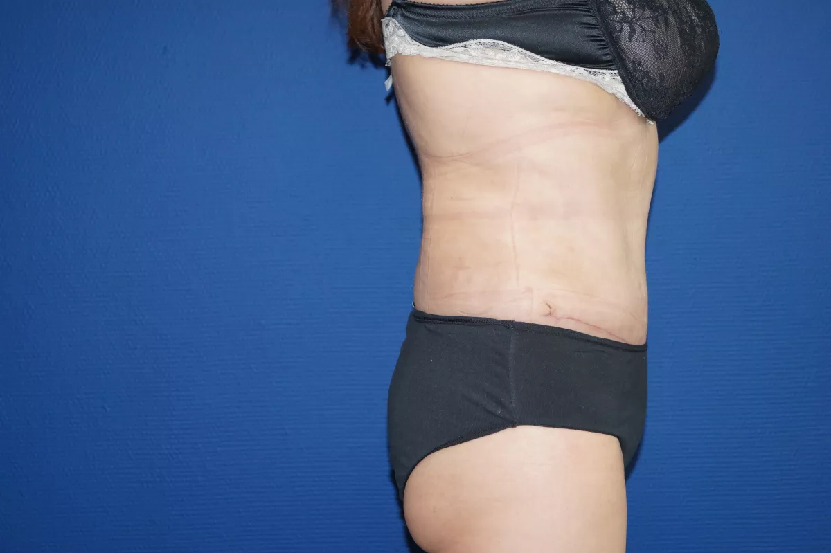 abdominoplastie marseille photo avant après