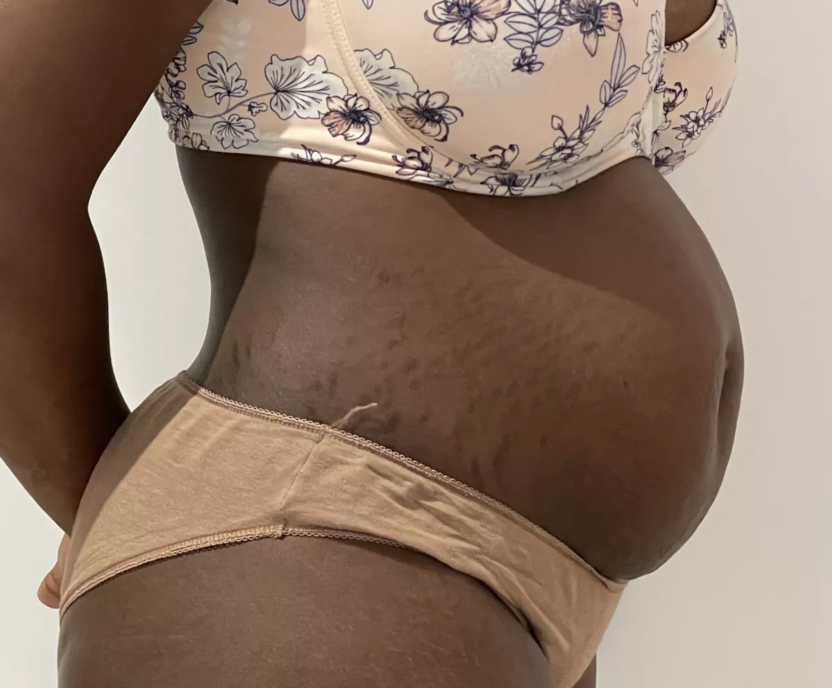 Abdominoplastie et diastasis musculaire à Marseille