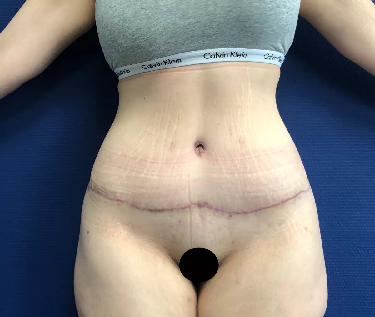 La cicatrice de l'abdominoplastie ou du bodylift