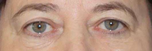 blepharoplastie marseille