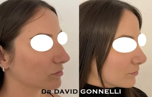 RHINOPLASTIE à Marseille