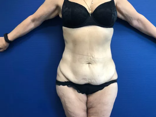 abdominoplastie marseille