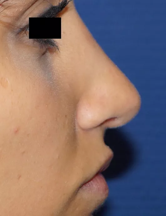 rhinoplastie marseille