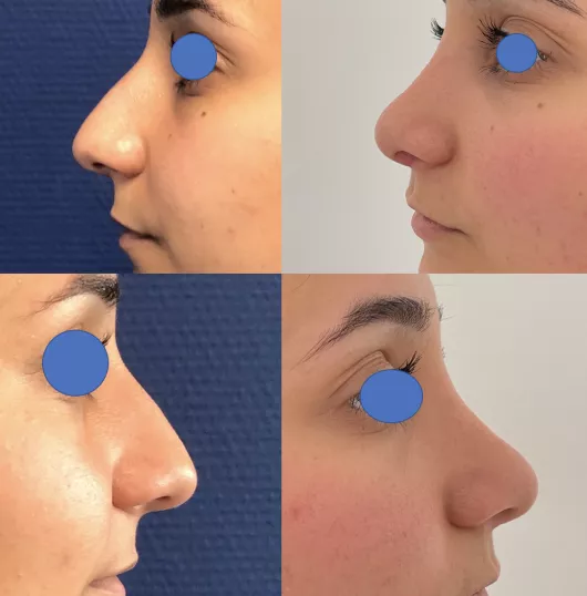 Rhinoplastie à Marseille