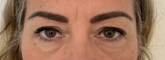 Blepharoplastie supérieure et inférieure