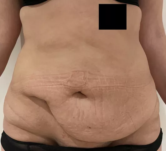 abdominoplastie marseille