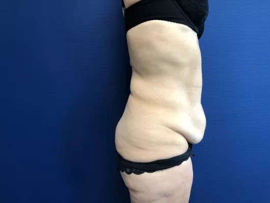 abdominoplastie