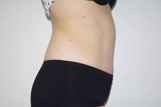 abdominoplastie marseille