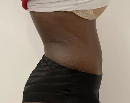 Abdominoplastie et diastasis musculaire à Marseille