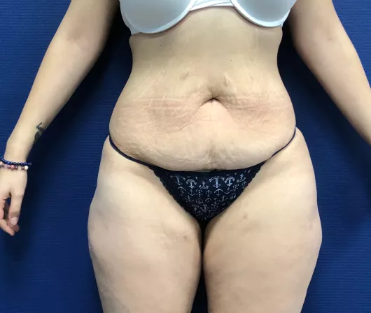 La cicatrice de l'abdominoplastie ou du bodylift